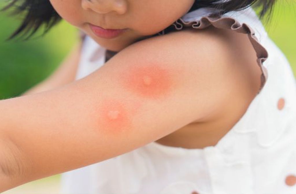 Come proteggere i nostri bambini dalle fastidiose zanzare.